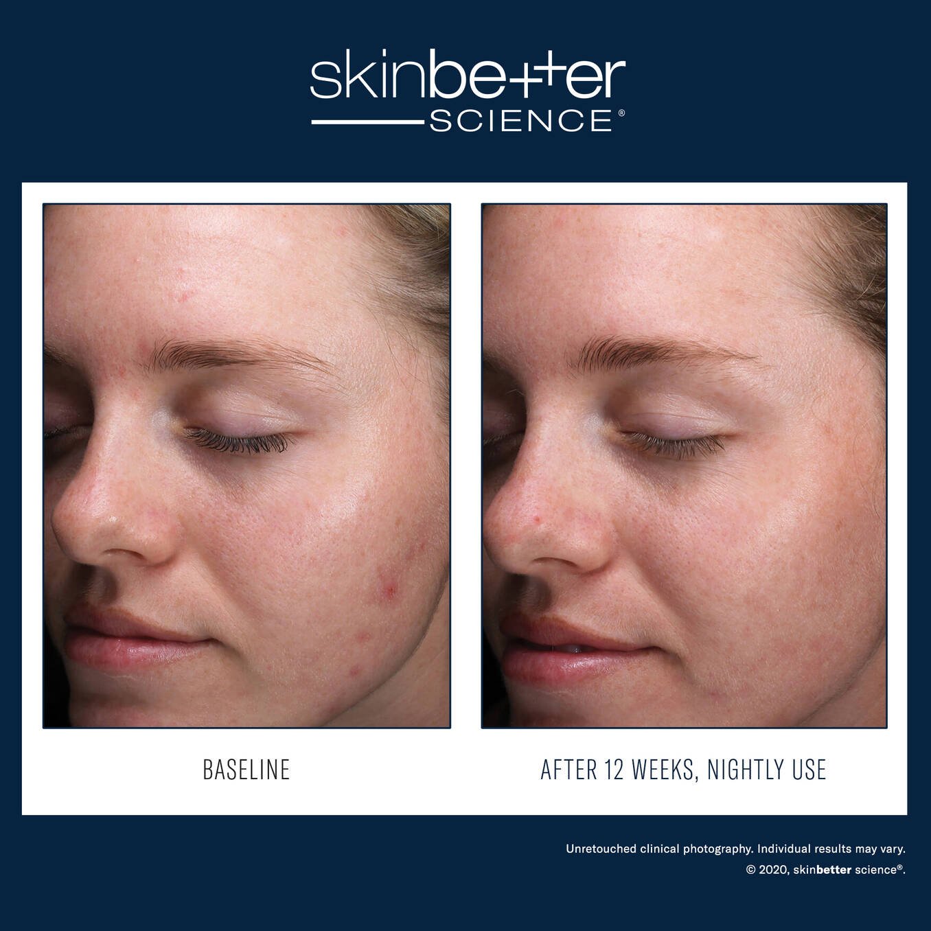 SkinBetter AlphaRet Clearing Serum 30ml